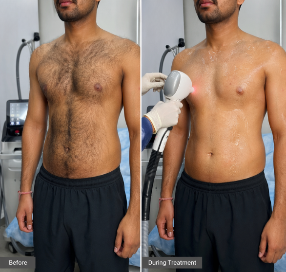 Male-Laser-Hair-Reduction.png