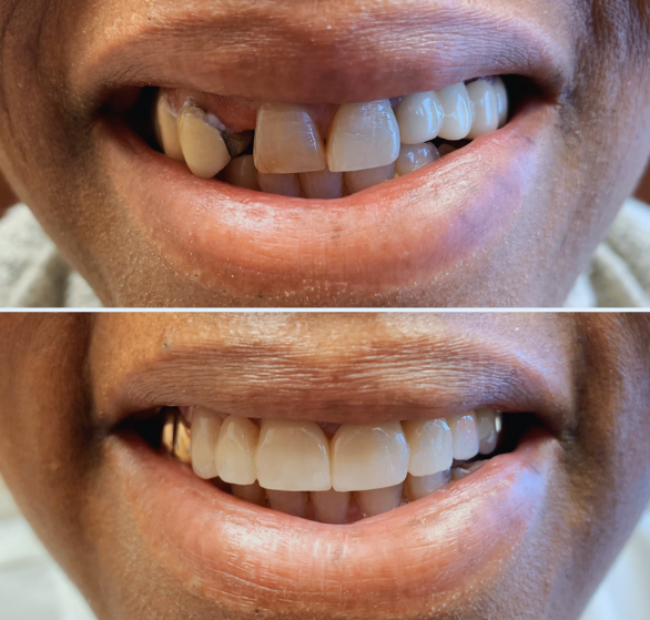 dental-bridges.png