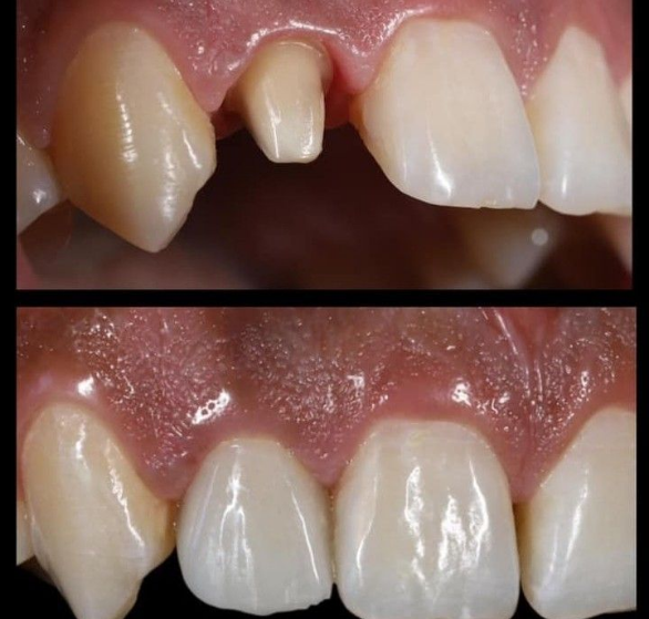 dental-crowns.png