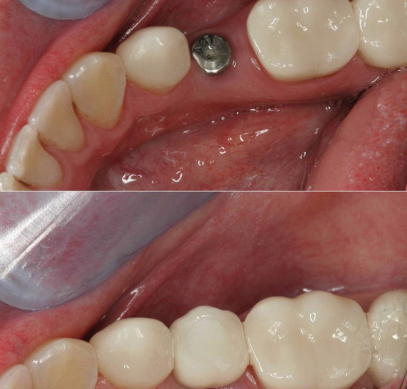 immediate-dental-implants.png