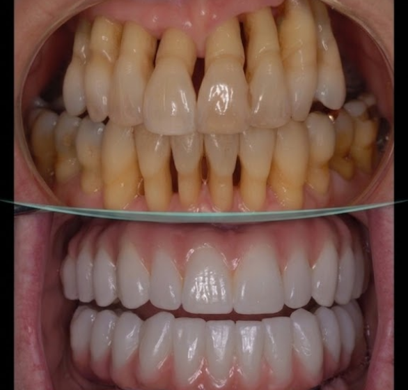 implant-supported-dentures.png
