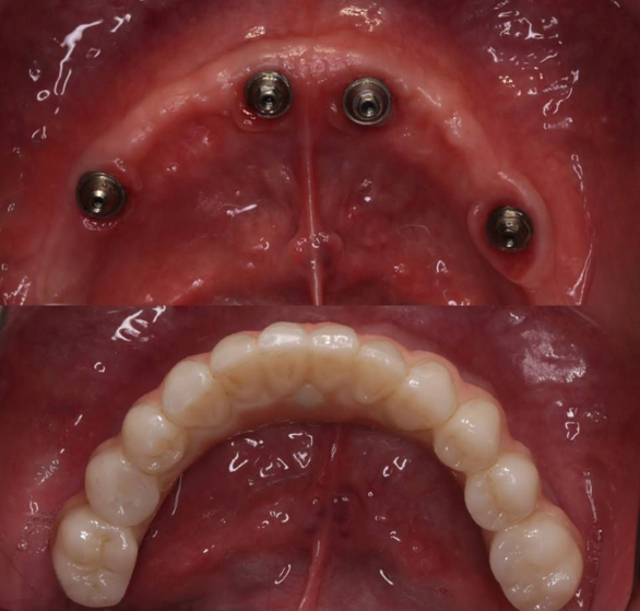full-mouth-dental-implants.png