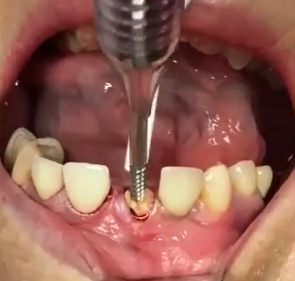 immediate-dental-implants.png