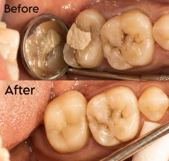 root-canal-treatment.png