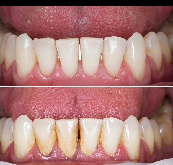 scaling-&-polishing-(teeth-cleaning).png