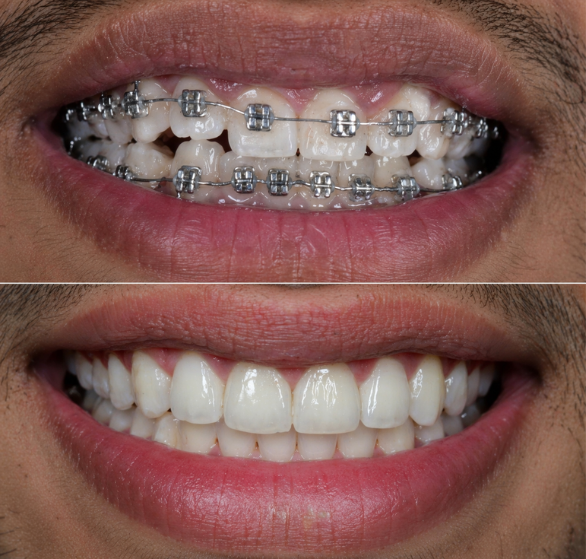 braces-treatment.png