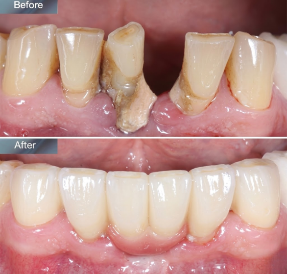dental-bridges.png