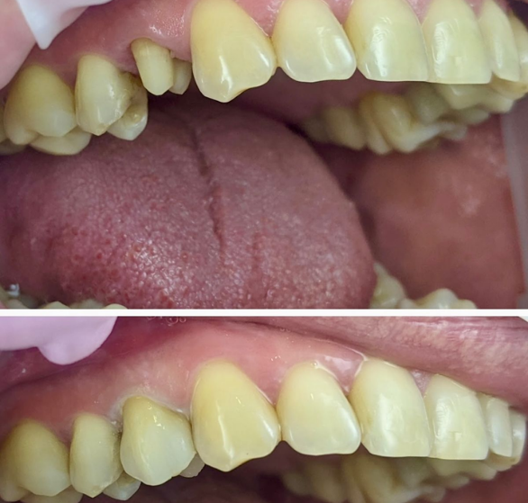 dental-crowns.png