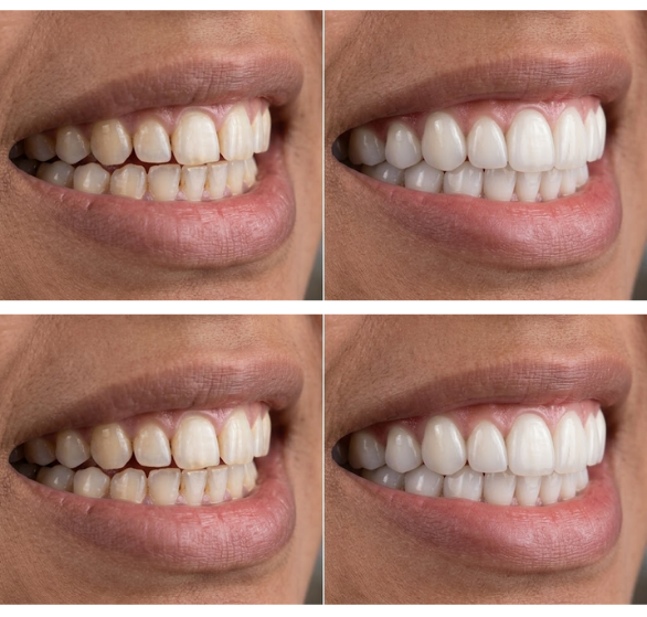 dental-veneers.png