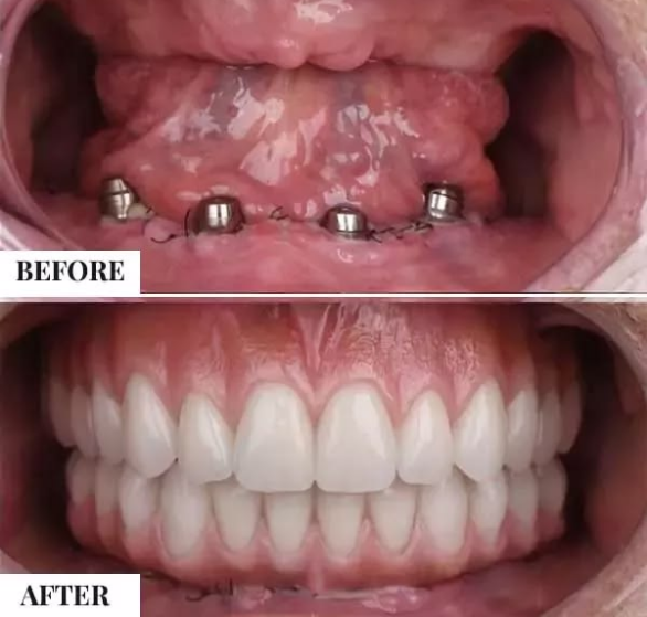full-mouth-rehabilitation.png