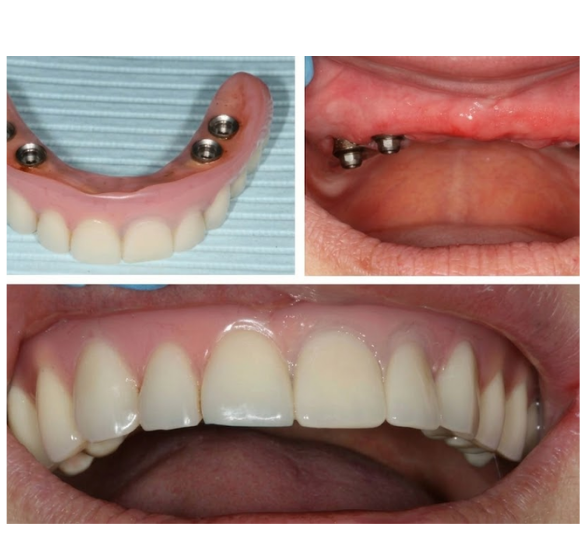 implant-supported-dentures.png