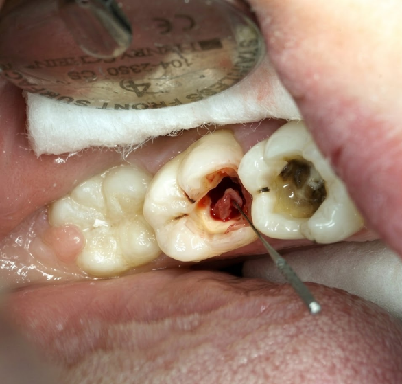 root-canal-treatment.png