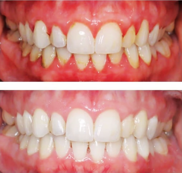 scaling-&-polishing-(teeth-cleaning).png