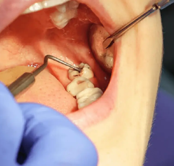 wisdom-tooth-removal.png