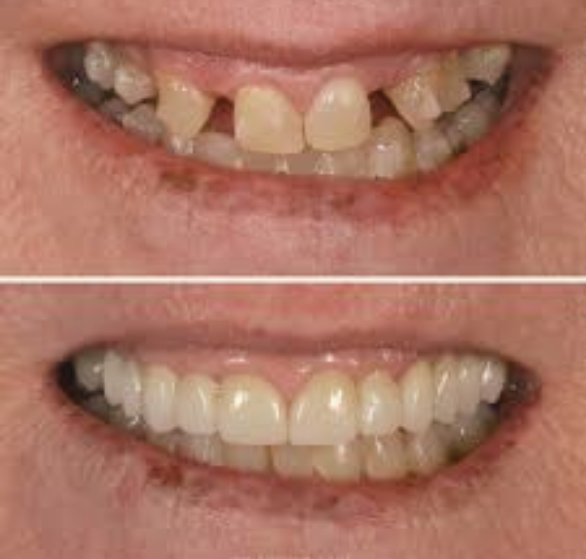 dental-bridges.png