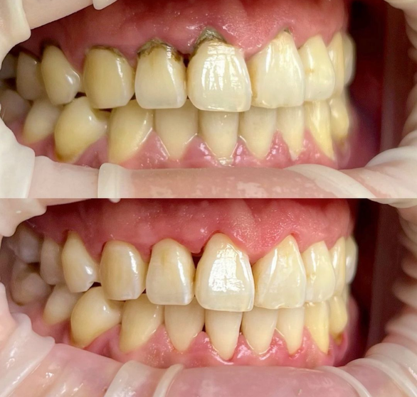 scaling-&-polishing-(teeth-cleaning).png