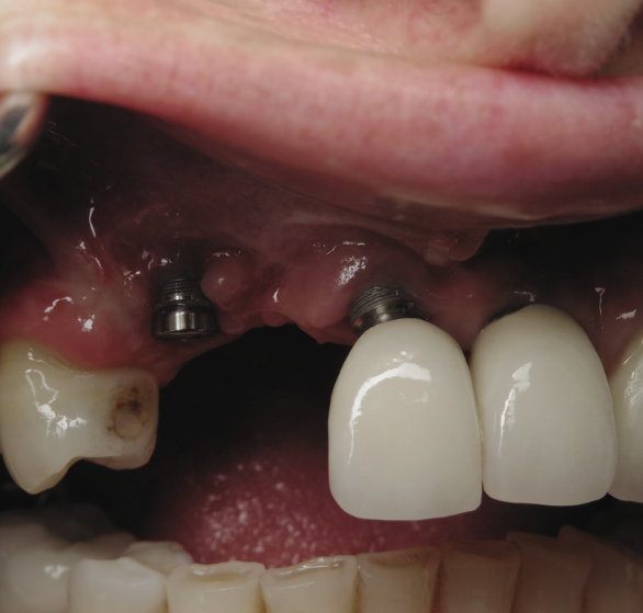 single-tooth-implant.png