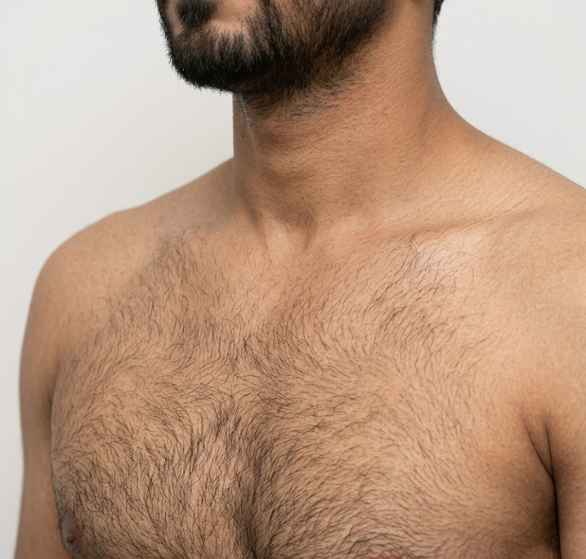 Body-Hair-Transplant.png