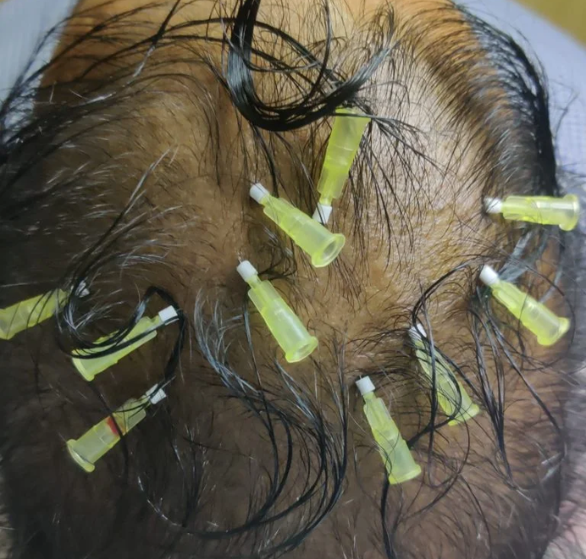 hair-thread-treatment.png