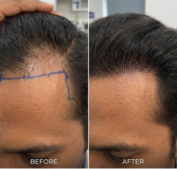 scalp-micropigmentation.png