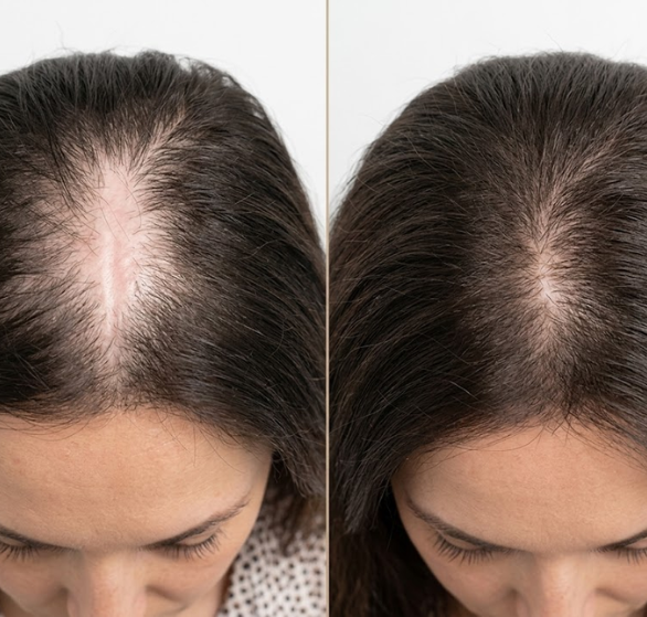 Hair-Transplant-on-Scars.png