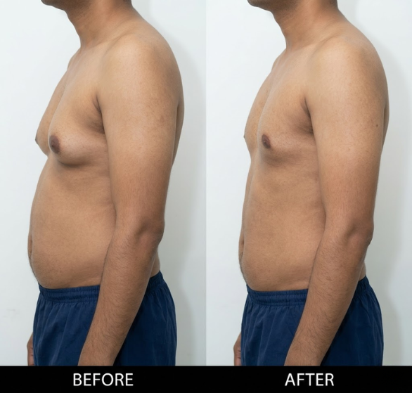 gynecomastia-surgery.png