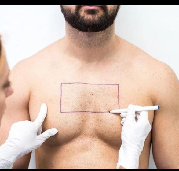 Body-Hair-Transplant.png