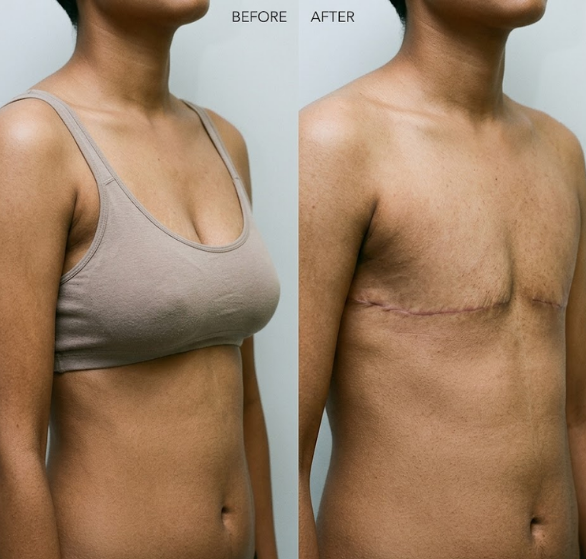chest-masculinization.png